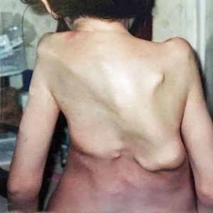 Jasmin Floyd was diagnosed with Fibrodysplasia Ossificans Progressiva when she was 5 years old in January 1999.